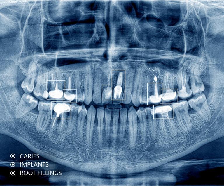 Object Detection on and X-ray image of human teeth
